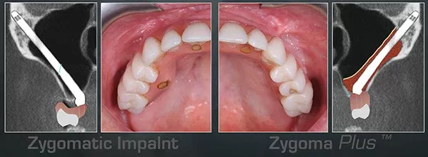 Zygomatic implants