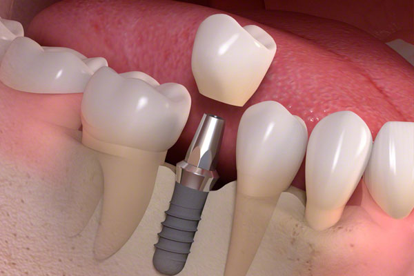  Dental implant bridges