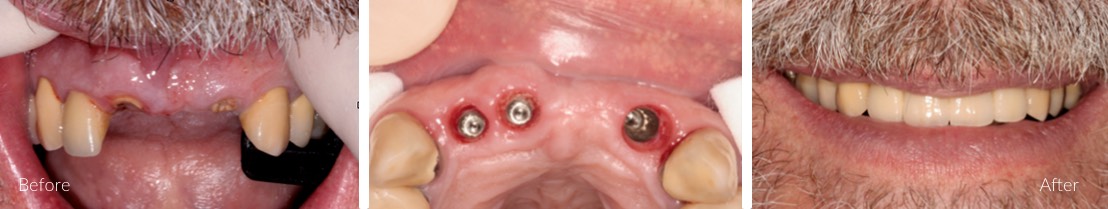implants for single teeth