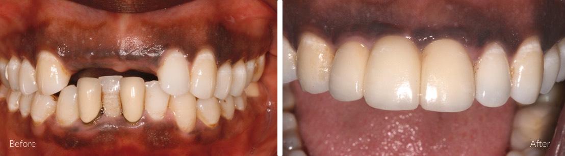implants for single teeth