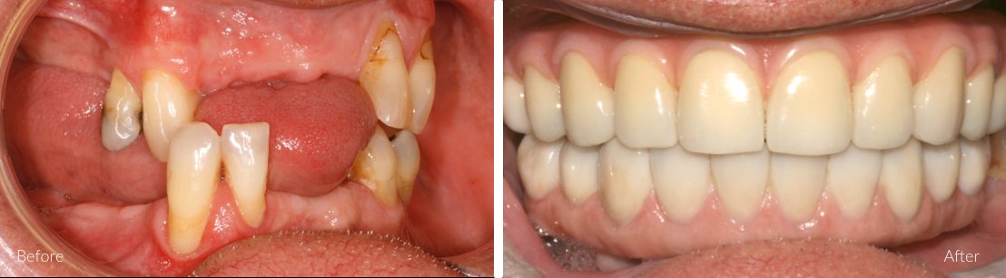 Full Teeth Replacement